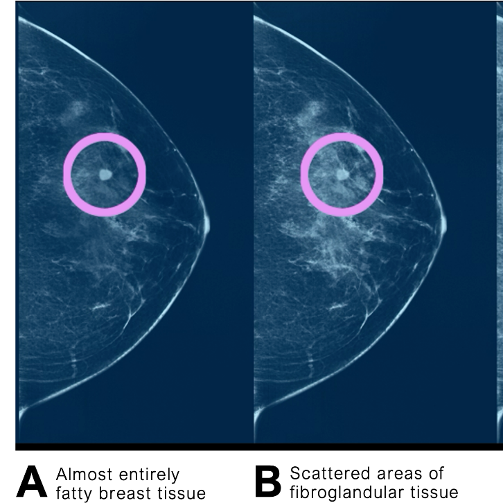 Illustration of dense breast tissue on a mammogram.